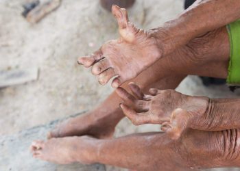 नेपालमा पछिल्लो ११ वर्षमा ३५ हजार कुष्‍ठरोगी थपिए