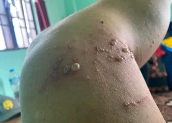 झापाका तीन पालिकामा ‘नाइरोबी फ्लाइ’का सङ्क्रमित भेटिए