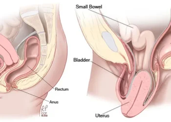 खोटाङमा पाठेघर खसेका महिलाको निःशुल्क उपचार
