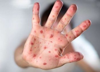 दाङ र कालीकोटमा पनि देखियो दादुरा